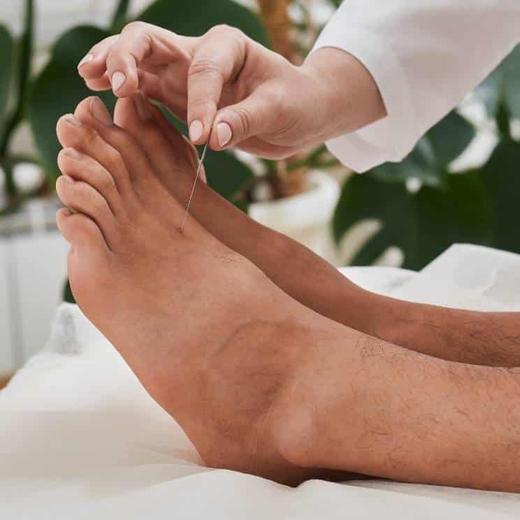 dry needling and acupuncture glasgow
