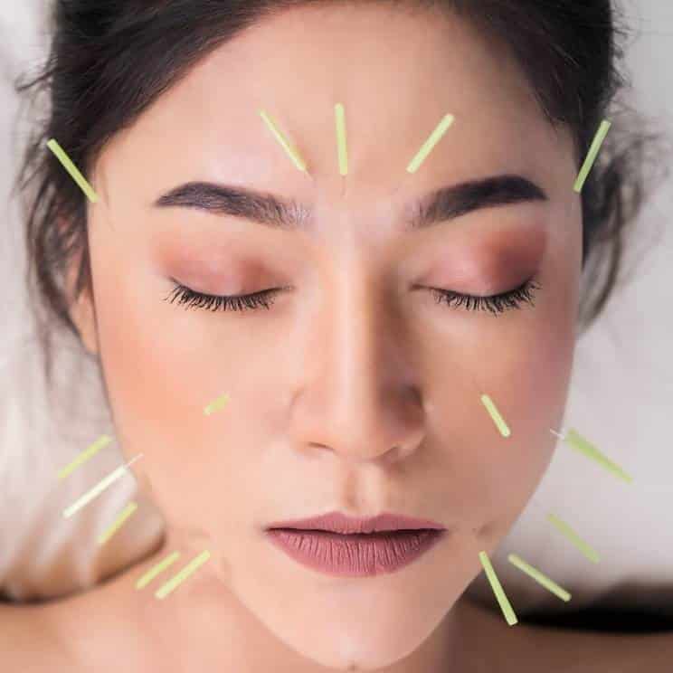 Acupuncture and dry needling treatment at Active Health Clinic Glasgow