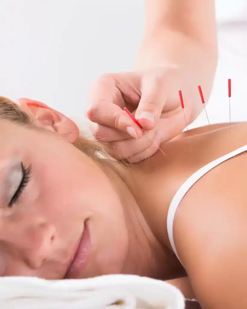 Acupuncture & Dry Needling glasgow